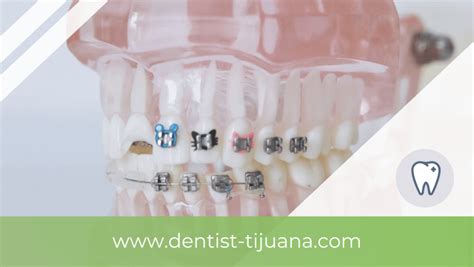 The 7 Most Frequently Asked Questions About Dental Braces Dentist Tijuana