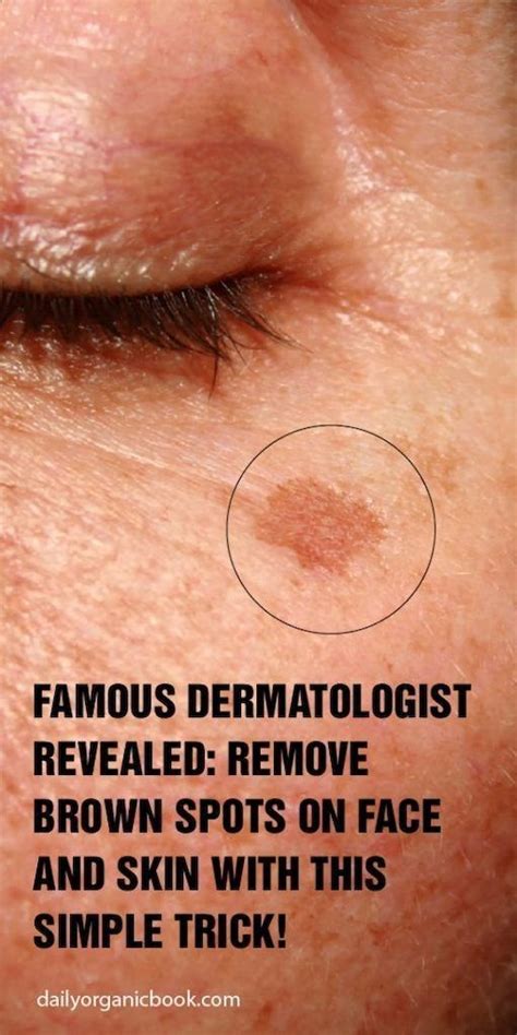 Famous Dermatologist Revealed Remove Brown Spots Spots On Face Brown