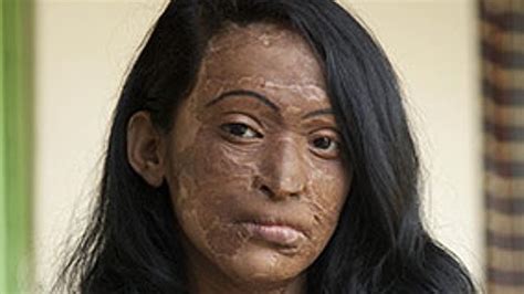 These Female Victims Of Acid Attacks Tell Their Horrifying Stories