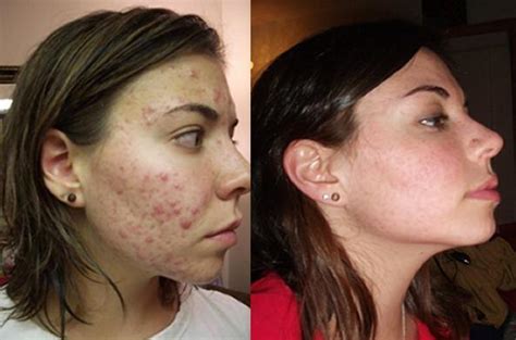 Accutane Before After 6 Real Women Share Their Accutane Experiences