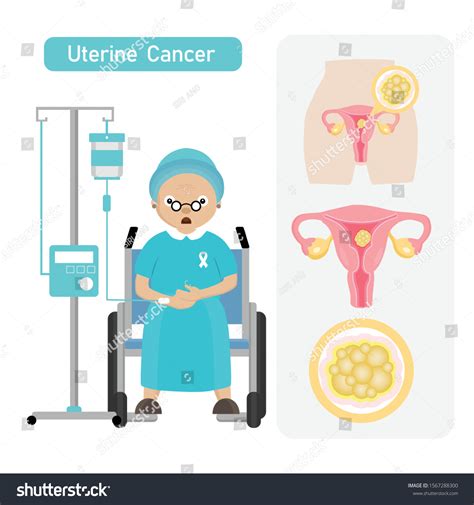 Senior Woman Patient Uterine Cancer Cartoon Stock Vector Royalty Free Shutterstock