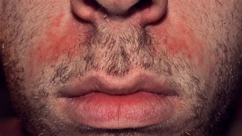 Yeast Infection On Face Symptoms