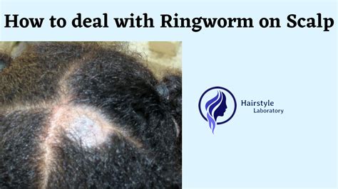 Ringworm On Scalp And How To Deal With It Hairstyle Laboratory