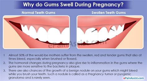 How To Relieve Swollen Gums During Pregnancy Tutorial Pics