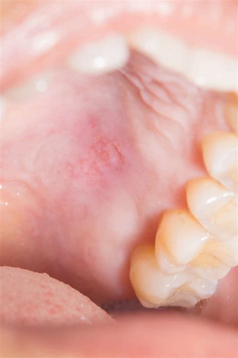 White Spots On Gums Cancer