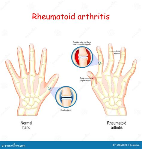 Rheumatoid Arthritis Healthy Hand And Hand With Rheumatoid Arthritis