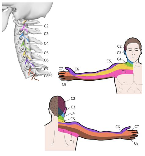 Pinched Nerves Dont Have To Be A ”pain In Your Neck” Physio Performance