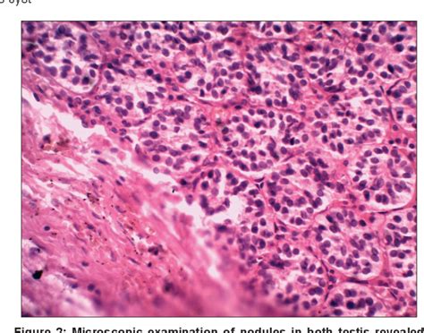 Pdf A Rare Case Of Bilateral Sertoli Cell Adenoma In Gonads Associated With Unilateral Serous