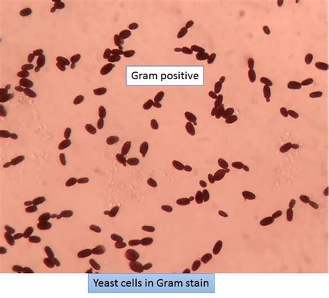 Yeast Cells In Gram Stain Stained Smear Lab Diagnosis Of Superficial