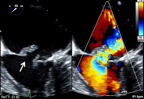 Advanced Echocardiography For The Diagnosis And Management Of Infective