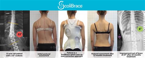 Scoliosis Treatment Foundation Spine And Posture