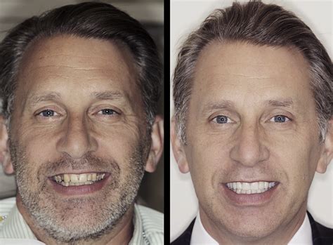 Lowenberg Lituchy Kantor Fix Male Smile Dental Implants Veneers