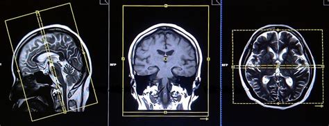 Mri Brain Planning ~ Kings Of Radiology
