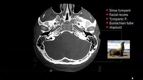 Imaging Of Petrous Bone I Prof Dr Mamdouh Mahfouz In Arabic Youtube