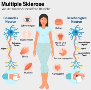 Multiple sclerosis (ms) is an unpredictable disease of the central nervous system that disrupts the flow of information within the brain, and between the brain and body. Ketogene Ernährung und Multiple Sklerose (MS) - ketoshop ...
