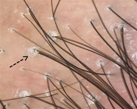 Lichen Planopilaris A Closer Look At Follicular Hyperkeratosis
