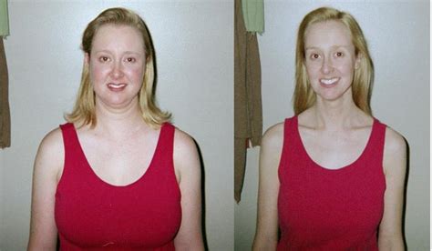 Beforeafter Cure Of Cushing Syndrome Not Me Rcushings