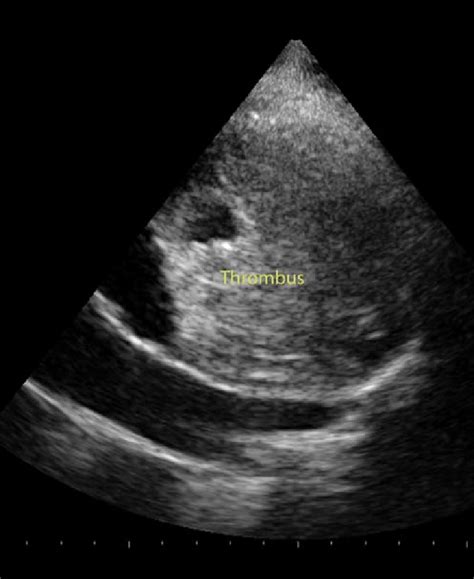 Right Parasternal Echocardiographic Window S A Image Showing The Huge