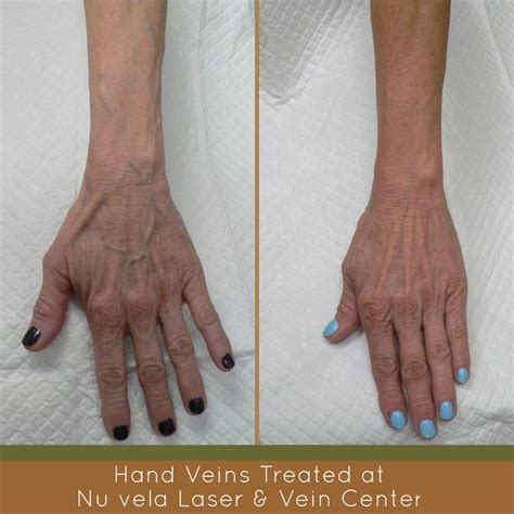 Sclerotherapy For Handvein Removal Before And After Photos Veins