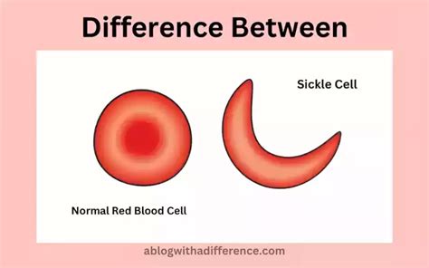 Normal Red Blood Cell And Sickle Cell Best 6 Difference