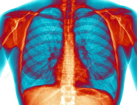 Healthy Lungs X Ray Stock Image C0096771 Science Photo Library
