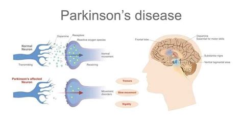Parkinsons Dementia Important Facts To Be Aware Of