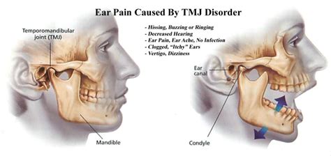 Ear Pain Ringing Head Pain Institute