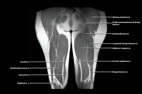 Mri Thigh