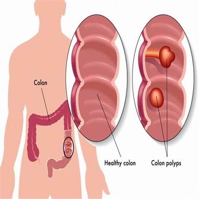 Colon Polyps Prevent Diet Cancer Colitis Ulcerative