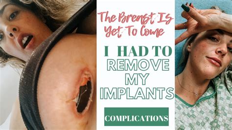 Refer to the breast implant removal medical coverage policy for additional information on breast implant removal. BREAST IMPLANT REMOVAL/REVISION | 3 WEEKS POST-OP | ALLERGIC REACTION | THE BREAST IS YET TO ...