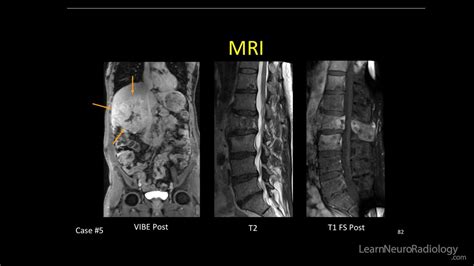 Neuroradiology Spine Lesions Case 5 Overview Choose Your Own