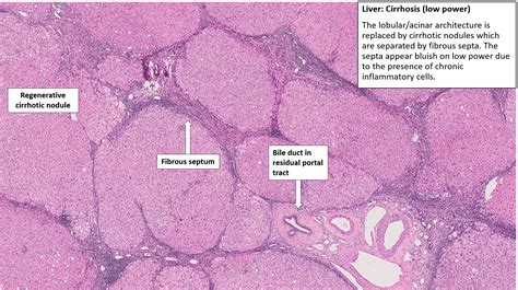 Liver Cirrhosis With Hepatocellular Carcinoma Nus Pathweb Nus