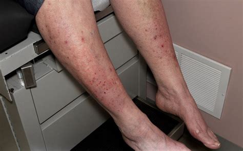 Dermatitis Herpetiformis And Gluten Intolerance What Is The Connectio