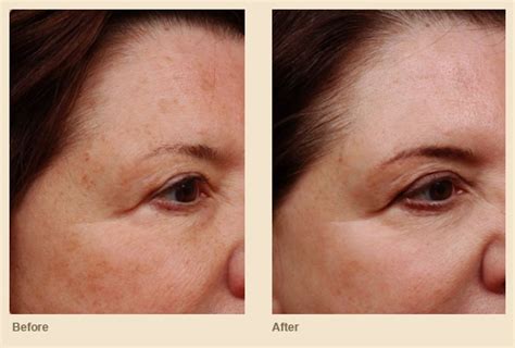 Aspire Dermatology Cosmetic Procedures Chemical Peels Ri Skin Doctors