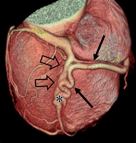 Coronary Artery Fistulas Pathophysiology Imaging Findings And