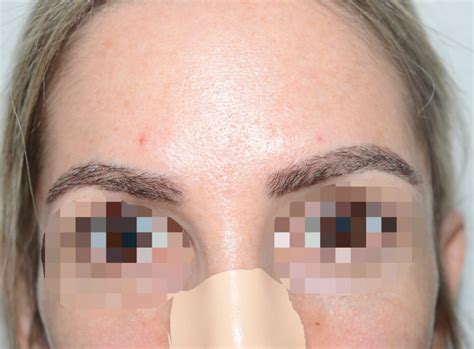 After an eyebrow transplant, the result is usually clearly visible after a short time. Eyebrow Transplant | Eyebrow Hair | Miami, FL | Foundhair