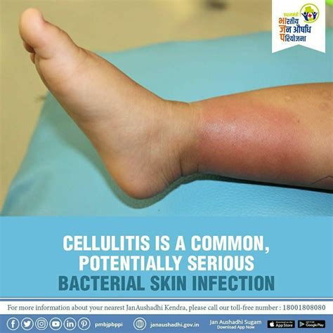 Cellulitis Is A Bacterial Infection Involving The Inner Layers Of The Skin Signs And Symptoms