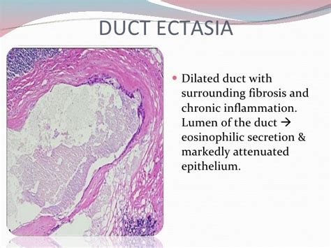 Breast Benign Disorders Pathology