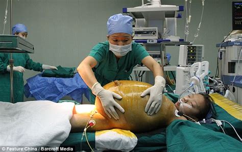 chinese girl successfully undergoes surgery to remove 33 pound tumour daily mail online