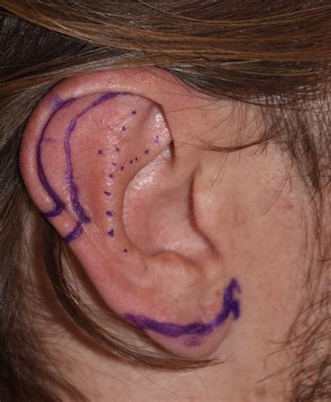 The Long Term Scar Results From Macrotia Reduction Vertical Ear