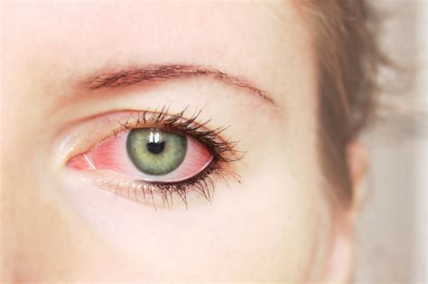 Top 10 Home Remedies For Sore Eyes —