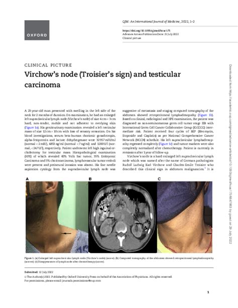 Pdf Virchows Node Troisiers Sign And Testicular Carcinoma