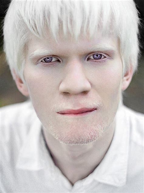 Albinism In Humans Pictures 26 Photos And Images
