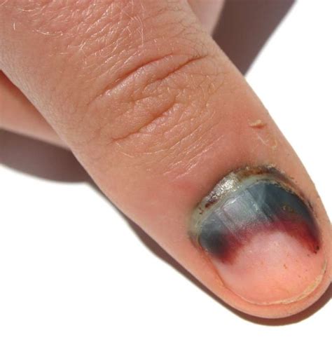 Top 115 What To Do If Nail Bed Is Damaged Architectures Eric