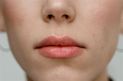 Small Bumps On Lips Fordyce Spots And How To Treat Them Maximum