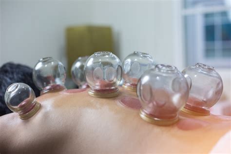 Cupping Therapy Katie Gaffney Omd Lac