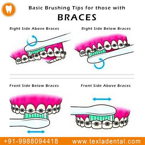 Have You Ever Wondered How People With Braces Should Brush Now You