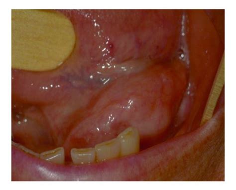 Hard Swelling Floor Of Mouth