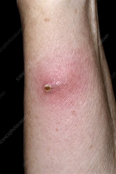 Abscess On Arm Stock Image C0478507 Science Photo Library