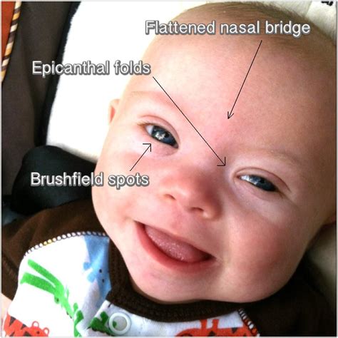 An epicanthal fold is a skin fold of the upper eyelid covering the inner corner of the eye. Indicators Of Down Syndrome In Pregnancy